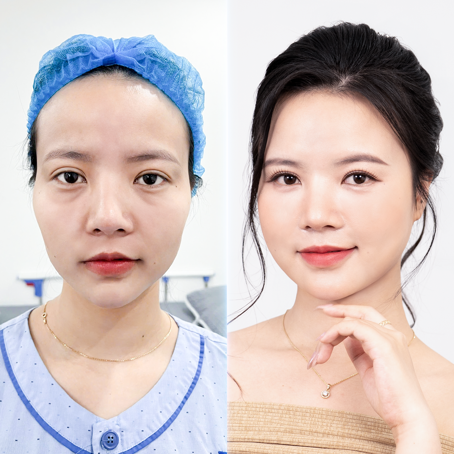 Xu hướng cấy mỡ tự thân kết hợp SVF: Giải pháp làm đầy trẻ hoá được giới chuyên môn đánh giá cao - 3