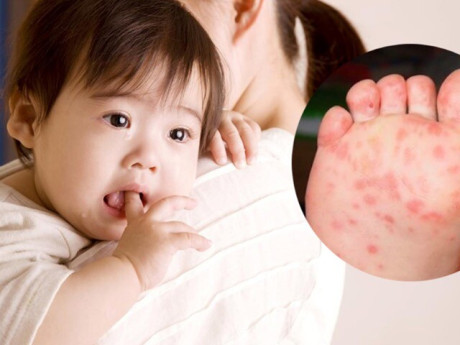 Bệnh tay chân miệng diễn biến phức tạp, chuyên gia chỉ 2 nguyên nhân và đưa giải pháp phòng bệnh kết hợp