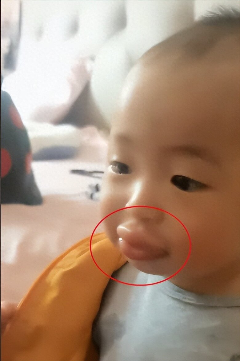 Con đi chơi bị ong đốt khiến môi sưng vù, người mẹ cứu sống con trong 20 phút, bác sĩ khen: Giỏi lắm! - 1