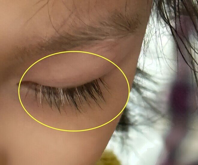 Con gái xinh xắn bỗng mọc lông mi màu trắng kỳ lạ, mẹ hoang mang đưa đến bệnh viện khám, bác sĩ lắc đầu - 1