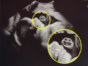 Bà bầu - Bức ảnh siêu âm phát hiện một “gương mặt” xuất hiện bên cạnh thai nhi khiến bác sĩ bật cười, mẹ bầu ngơ ngác