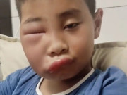 Vừa nghỉ hè cuối tuần về chơi với ông bà ở quê, bé trai khiến mẹ phát hoảng với gương mặt biến dạng