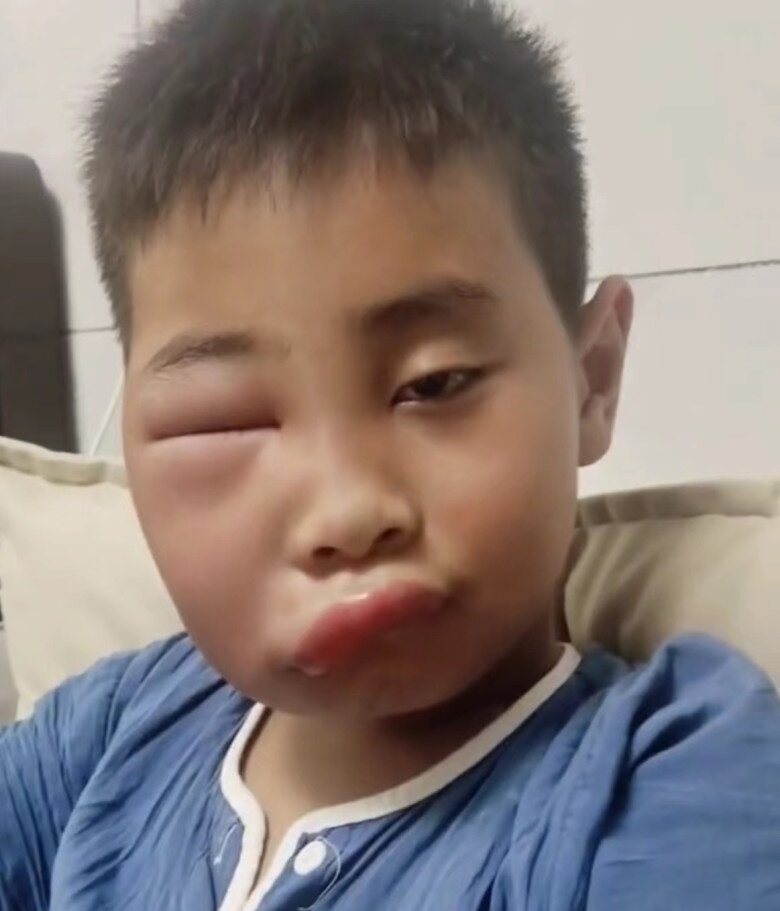 Vừa nghỉ hè cuối tuần về chơi với ông bà ở quê, bé trai khiến mẹ phát hoảng với gương mặt biến dạng - 1