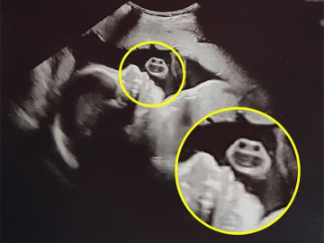 Bức ảnh siêu âm phát hiện một “gương mặt” xuất hiện bên cạnh thai nhi khiến bác sĩ bật cười, mẹ bầu ngơ ngác