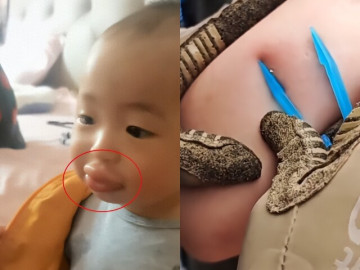Yêu con - Con đi chơi bị ong đốt khiến môi sưng vù, người mẹ cứu sống con trong 20 phút, bác sĩ khen: Giỏi lắm!