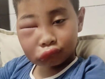 Yêu con - Vừa nghỉ hè cuối tuần về chơi với ông bà ở quê, bé trai khiến mẹ phát hoảng với gương mặt biến dạng