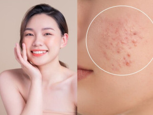 Da dễ sạm, đổ dầu và nổi mụn mùa Hè? Đây là những cách giúp làn da sáng khỏe hơn mỗi ngày