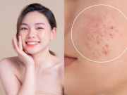Đẹp - Da dễ sạm, đổ dầu và nổi mụn mùa Hè? Đây là những cách giúp làn da sáng khỏe hơn mỗi ngày