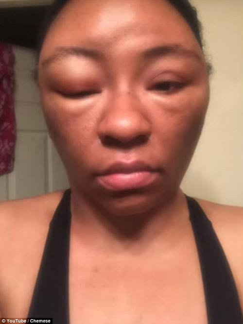 Kinh hãi những khuôn mặt phồng rộp, biến dạng vì thuốc nhuộm tóc