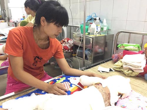 Bé gái 2 tuổi bỏng toàn thân, phẫu thuật 4 lần/tháng vì hóa chất thông cống dính vào người - 1