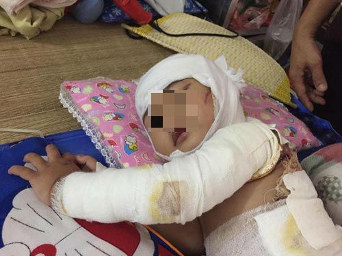 Bé gái 2 tuổi bỏng toàn thân, phẫu thuật 4 lần/tháng vì hóa chất thông cống dính vào người - 2