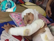 Tin tức - Bé gái 2 tuổi bỏng toàn thân, phẫu thuật 4 lần/tháng vì hóa chất thông cống dính vào người