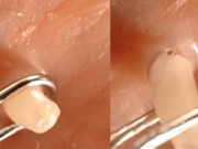 Clip Eva - [Video] Pha nặn mụn trứng cá to hơn hạt gạo thu hút hơn 6 triệu lượt xem