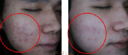 Mách bạn 3 cách trị sẹo, vết thâm mụn đơn giản hiệu quả - 9