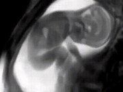 Bà bầu - Nam bác sĩ sản khoa khoe clip thai nhi 26 tuần nhảy múa tung tăng đốn tim các mẹ bầu