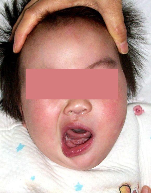 Con gái 3 tuổi liệt mặt, méo miệng, bố mẹ sốc nặng khi nghe bác sĩ nói - 1