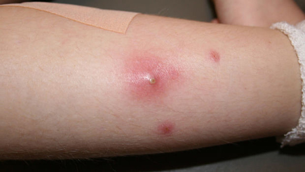 Cách phân biệt mụn nhọt thông thường và ung thư da - 2