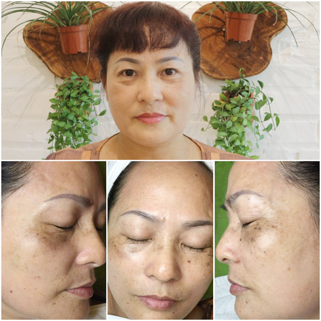 Laser Toning FFP – công nghệ amp;#34;thần thánhamp;#34; cứu cánh cho các chị em da nám - 5
