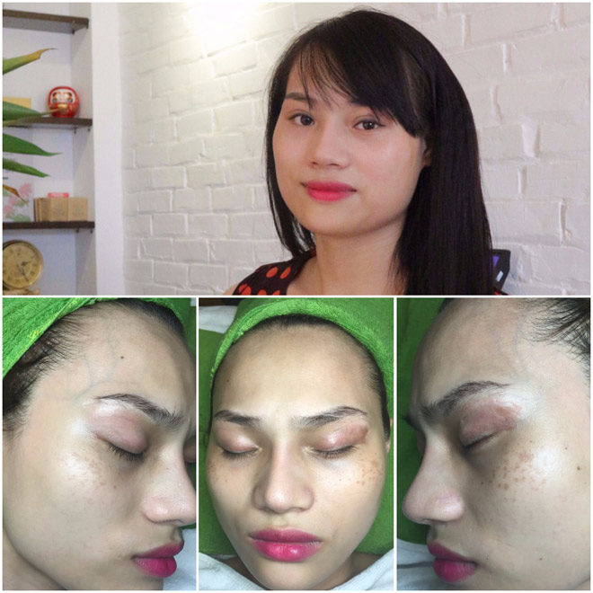 Laser Toning FFP – công nghệ amp;#34;thần thánhamp;#34; cứu cánh cho các chị em da nám - 6