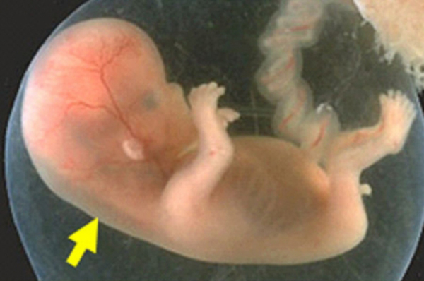 Độ mờ da gáy thai nhi – những điều mẹ bầu nào cũng cần biết - 1