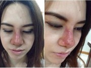 Làm đẹp - Tuyệt đối tránh xa vùng "tam giác tử thần" và những sai lầm khi nặn mụn