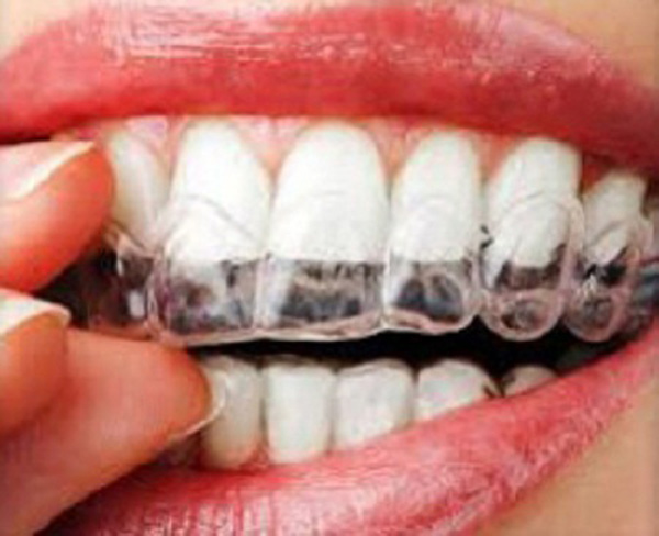 Những điều nên biết khi tẩy trắng răng - 1