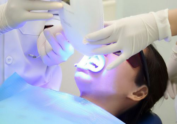 Những điều nên biết khi tẩy trắng răng - 2