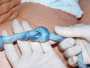 Bà bầu - Thắt nút dây rốn: Nhìn thì lạ nhưng cực nguy hiểm với thai nhi