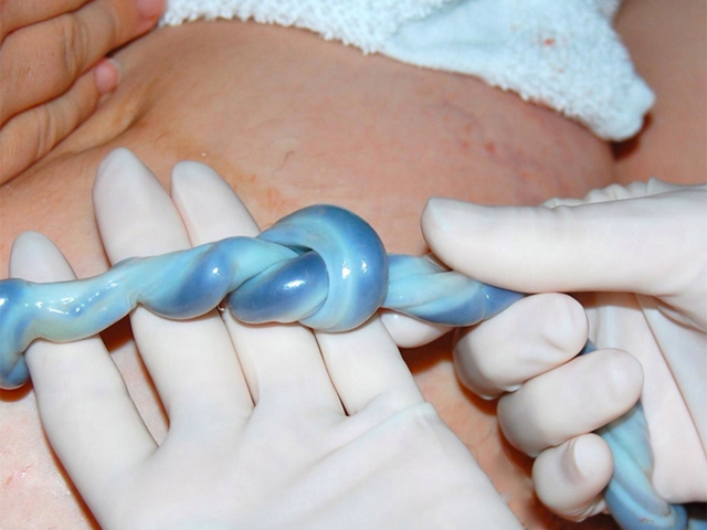 Thắt nút dây rốn: Nhìn thì lạ nhưng cực nguy hiểm với thai nhi - 1