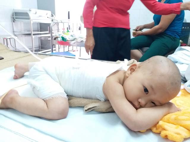 Con gái 16 tháng tuổi bị bỏng, mẹ bôi kem đánh răng làm mát nhận cái kết đau lòng - 1