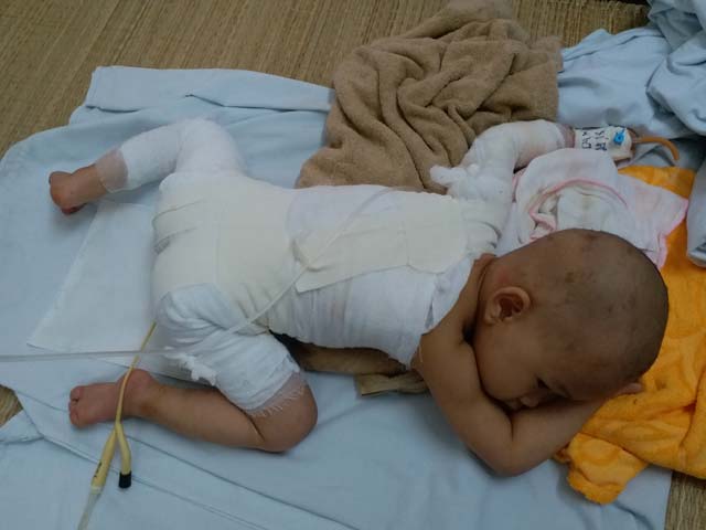 Con gái 16 tháng tuổi bị bỏng, mẹ bôi kem đánh răng làm mát nhận cái kết đau lòng - 4