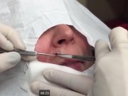 Clip Eva - Pha nặn mụn khổng lồ dưới mũi thu hút hơn 14 triệu lượt xem