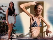 Làm đẹp - 5 cô gái trẻ xinh đẹp hóa "bộ xương khô" vì giảm cân quá mức