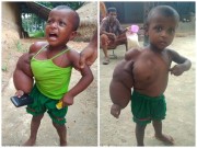 Làm mẹ - Bé gái 2 tuổi mắc bệnh lạ khiến tay phải sưng phù, nặng gần 3kg