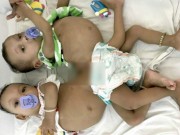 Tin tức - Nằm trên bàn mổ, mẹ đau đớn thấy 2 con gái song sinh chào đời chỉ có 1 cái mông