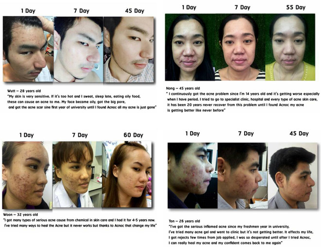 Trị sạch mụn bằng vỏ quả măng cụt? - 3