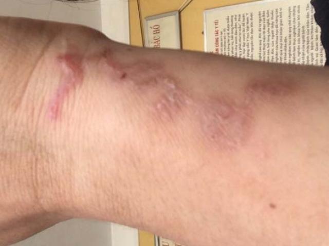 Hà Nội: Người phụ nữ thất thần khi phát hiện ấu trùng bò lổm ngổm dưới da