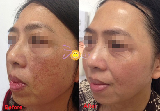 Phương pháp mới xóa sạch nám da, tàn nhang chỉ sau 1 lần duy nhất - 1