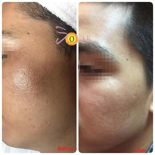 Phương pháp mới xóa sạch nám da, tàn nhang chỉ sau 1 lần duy nhất - 2
