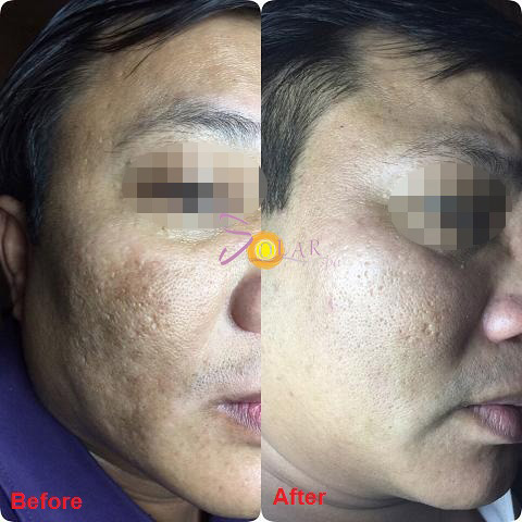 Phương pháp mới xóa sạch nám da, tàn nhang chỉ sau 1 lần duy nhất - 3