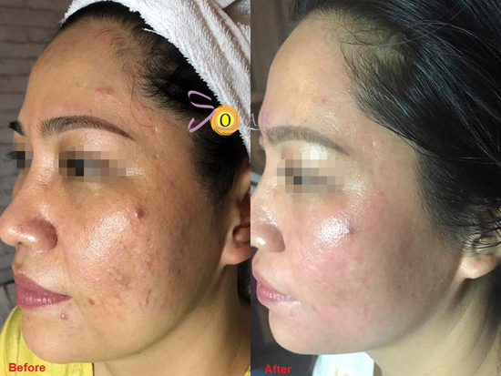 Phương pháp mới xóa sạch nám da, tàn nhang chỉ sau 1 lần duy nhất - 4