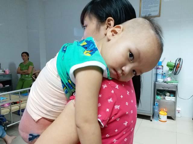 Mẹ ân hận vì sơ cứu bỏng sai cách khiến con trai bị lột hết cả da lưng