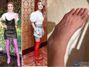 Thời trang - Siêu sao Hoa Ngữ biến dạng bàn chân vì sở thích đi giày cao gót quái chiêu