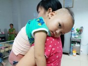 Tin trong nước - Mẹ ân hận vì sơ cứu bỏng sai cách khiến con trai bị lột hết cả da lưng