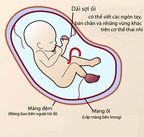 Thai nhi trong bụng mẹ bị dải sợi ối cắt gần đứt chân, bác sĩ nói amp;#34;may mà sinh nonamp;#34; - 4