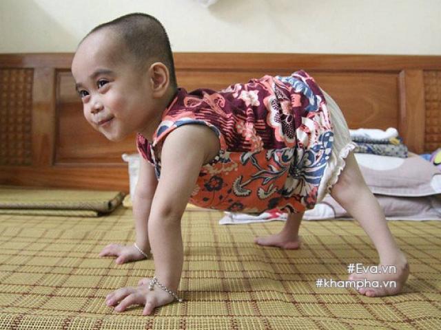 Em bé đi bằng 4 chân, sống nhờ vào những chiếc bao cao su và băng vệ sinh