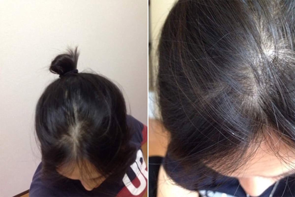 Mỗi ngày 5 phút thôi, tóc dù mỏng hay rụng nhiều cũng mọc lên ầm ầm - 1