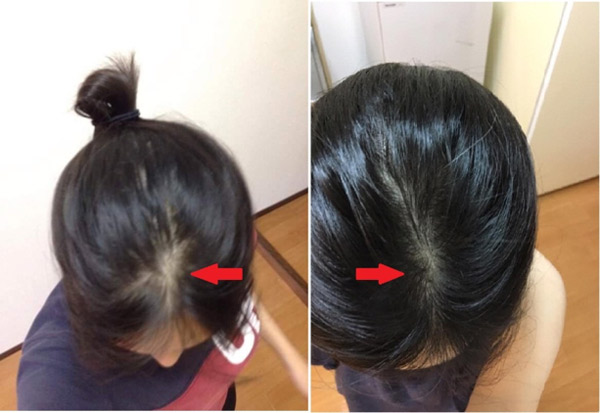 Mỗi ngày 5 phút thôi, tóc dù mỏng hay rụng nhiều cũng mọc lên ầm ầm - 3