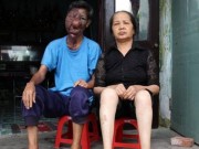 Tin tức - Chuyện tình cảm động của ông lão ăn xin có khuôn mặt biến dạng