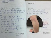 Tin tức - Hà Nội: Học sinh lớp 2 bị cô giáo đánh tím hai chân vì vào lớp muộn